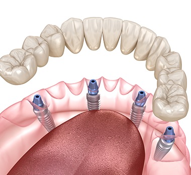 Digital illustration of all-on-4 dental implants