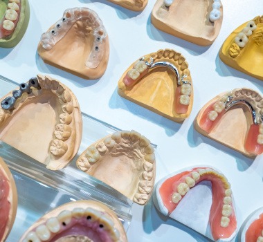 Several models of mouths with different types of dentures on them